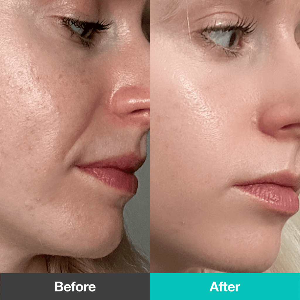 Acne&Dark Spot Repair Set